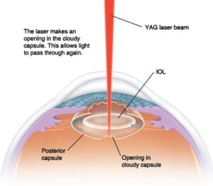 Snead Eye Group Yag Laser Procedure